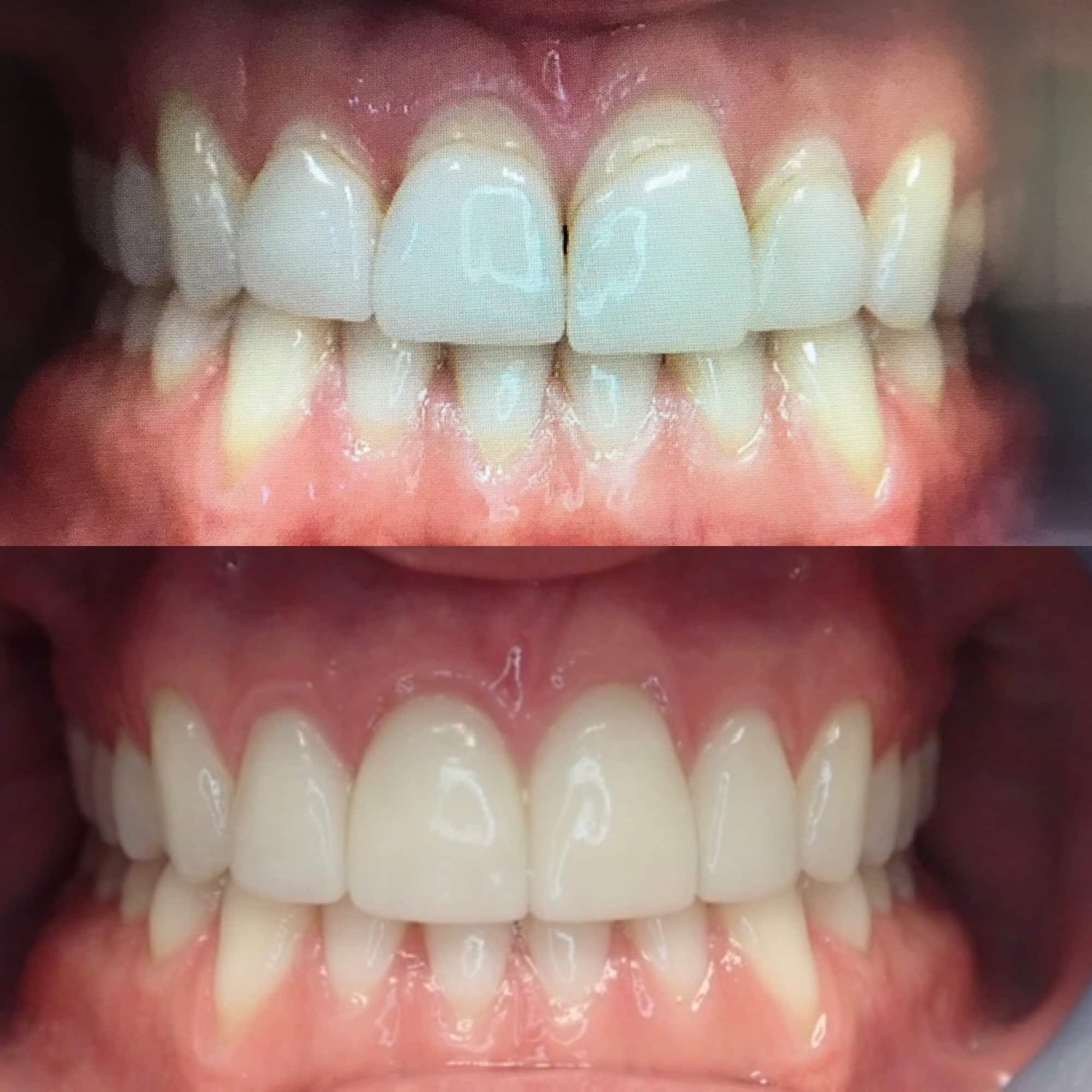 Veneers & Lumineers in Denver OG Dental 80211